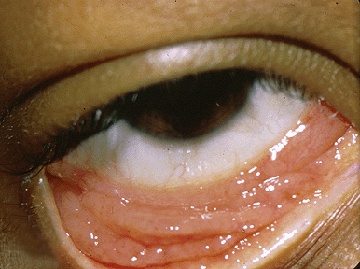 Chlamydien-Konjunktivitis Chlamydien-Bilder: Chlamydien-Konjunktivitis