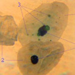 Chlamydia pneumoniae Symptome und Ursachen Chlamydia pneumoniae Symptome und Ursachen